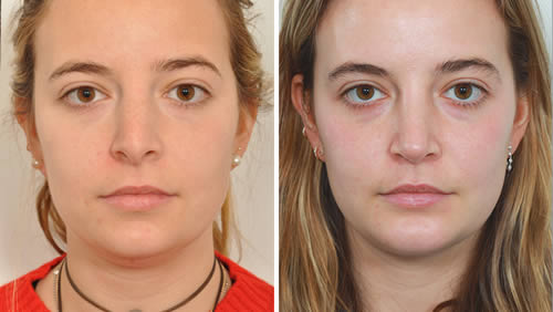 photo-rhinoplastie-ratee