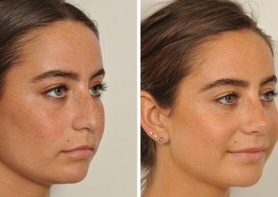 photo-rhinoplastie-avant-apres