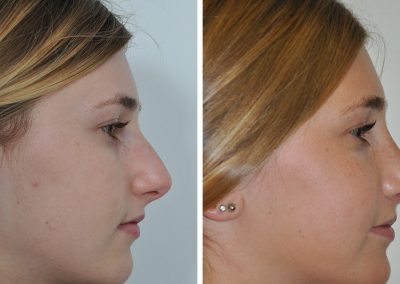 photo-rhinoplastie-avant-apres-1