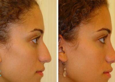photo-rhinoplastie-avant-apres-7