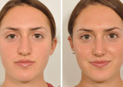 photo-rhinoplastie-avant-apres-2