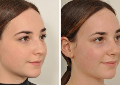photo-rhinoplastie-avant-apres-3