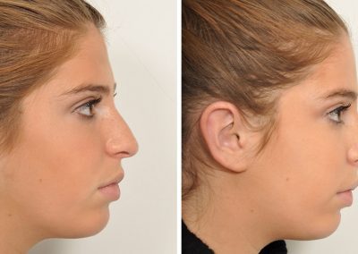 photo-rhinoplastie-avant-apres-4