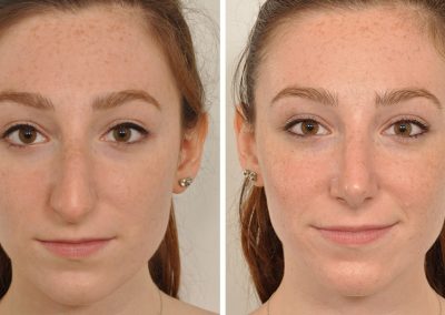 photo-rhinoplastie-avant-apres-5