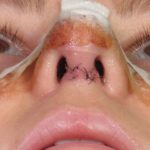 photo-rhinoplastie-procedure-ouverte-ou-fermee-details-ouverte