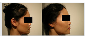 photo-rhinoplastie-medicale-avant-apres-1