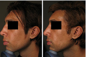 photo-rhinoplastie-medicale-avant-apres-2