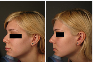 photo-rhinoplastie-medicale-avant-apres-3