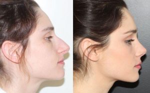 photo-rhinoplastie-avantages-apercu