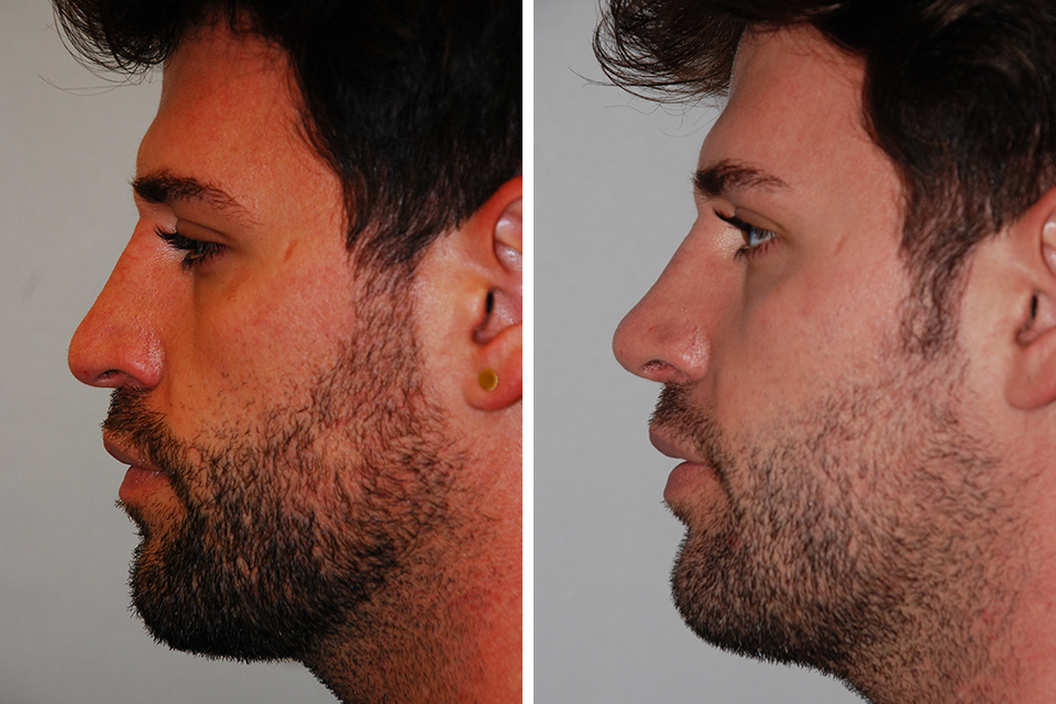 photo-rhinoplastie-homme