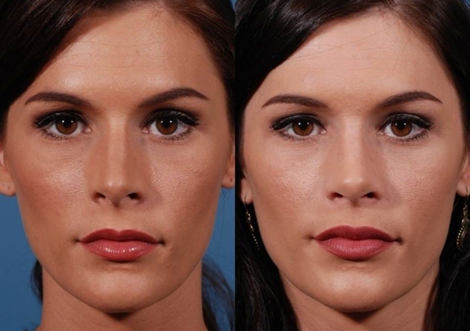 Rhinoplastie secondaire : comment faire revoir sa première rhinoplastie ?