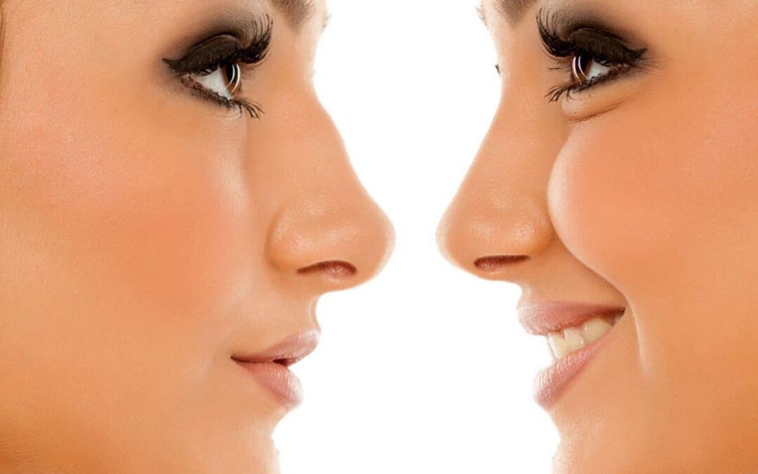 Réussir la rhinoplastie grâce à un médecin esthétique