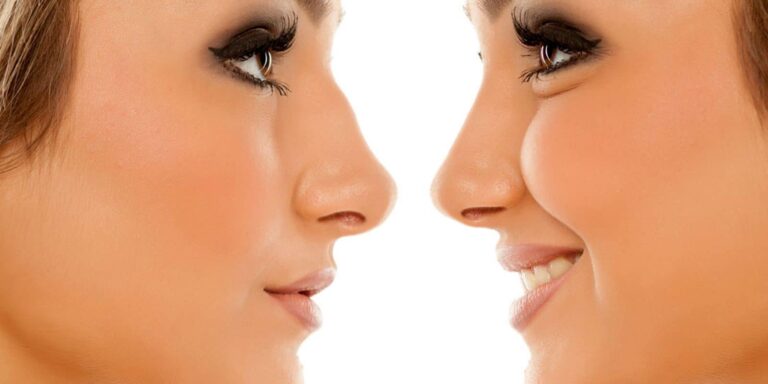 rhinoplastie